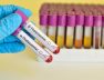 thalassemia N.T